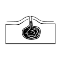 pilonidal sinus